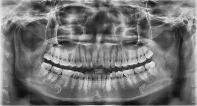 Người bệnh cần chụp X-quang trước khi tiến hành trồng răng Implant