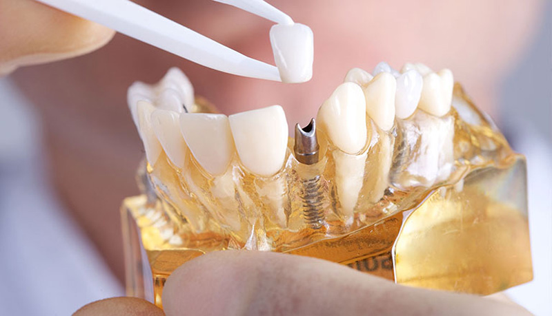 Giá trồng răng Implant ở các trung tâm nha khoa Hà Nội bị ảnh hưởng bởi nhiều yếu tố