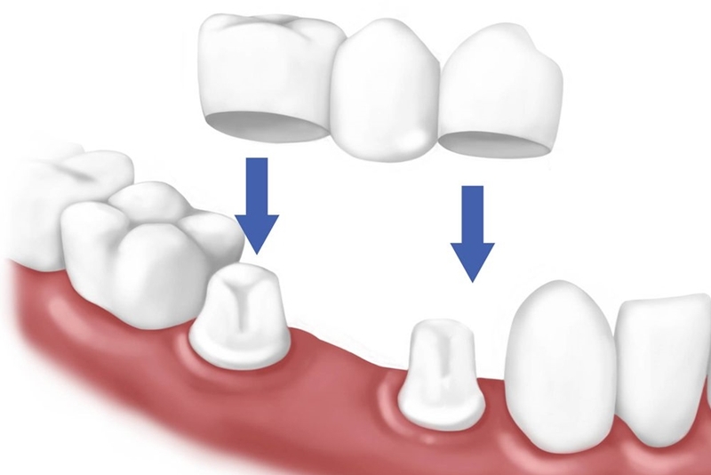 Làm cầu răng sứ là cách trồng răng khá phổ biến