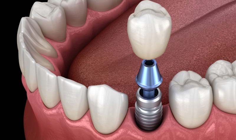 Cắm Implant là giải pháp phục hình răng mất mang lại hiệu quả cao