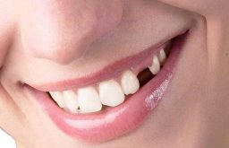 [Chuyên Gia Giải Đáp] Mất Răng Lâu Năm Có Trồng Được Không?