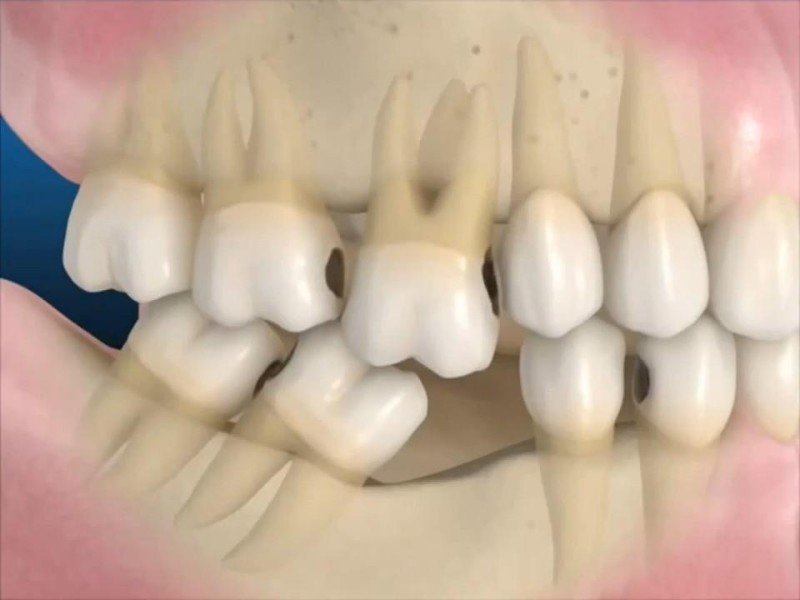 Mất răng lâu ngày khiến các răng khác bị xô lệch vị trí, yếu hơn so với bình thường