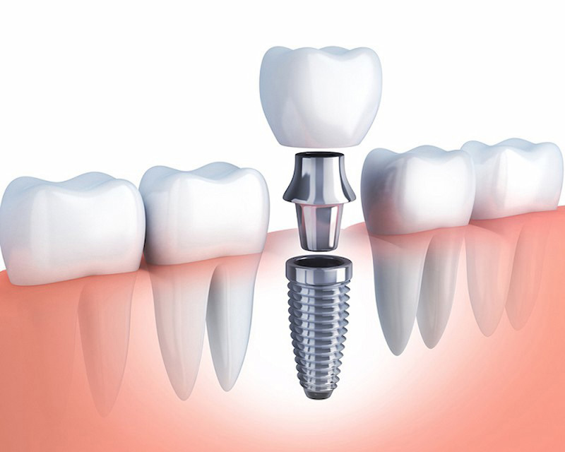 Trồng răng Implant là phương pháp phục hình răng được nhiều người tin chọn