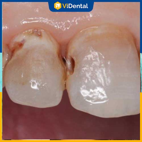Răng sâu, viêm chân răng không được thăm khám kịp thời