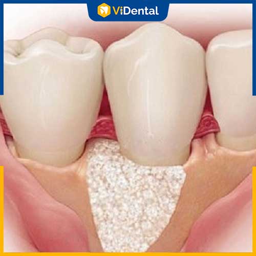 Tiêu xương là bệnh lý nguy hiểm xảy ra ở các trường hợp niềng răng