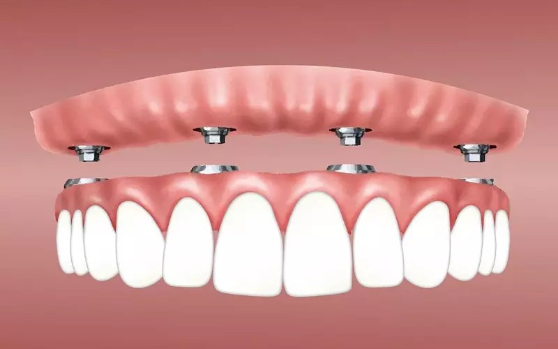Trồng răng 2 hàm giá bao nhiêu phụ thuộc vào phương pháp được lựa chọn