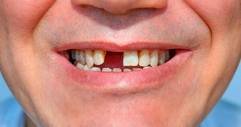 Trồng răng giả phù hợp với người bị mất một hoặc nhiều răng