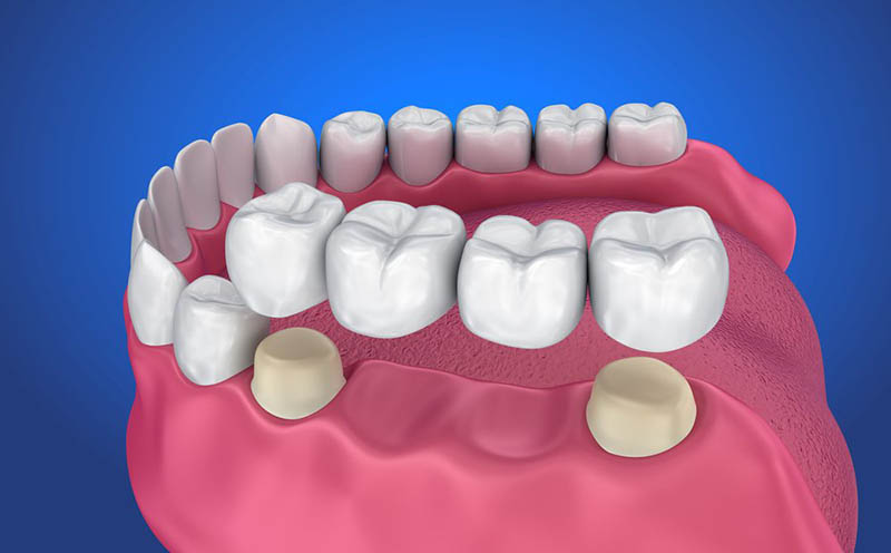 Bắc cầu răng sứ người bệnh cần cần mài 2 răng để và lắp thêm 3 chiếc răng giả mới