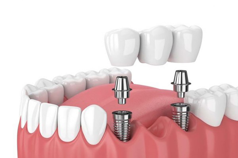 Trồng răng hàm bằng cách cấy ghép Implant đang rất được ưa chuộng