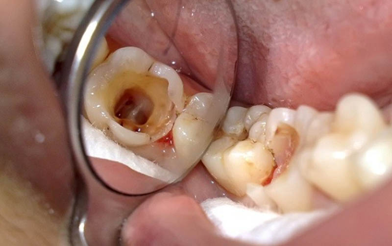 Cần trồng răng hàm bị sâu khi tình trạng sau nghiêm trọng phải nhổ bỏ