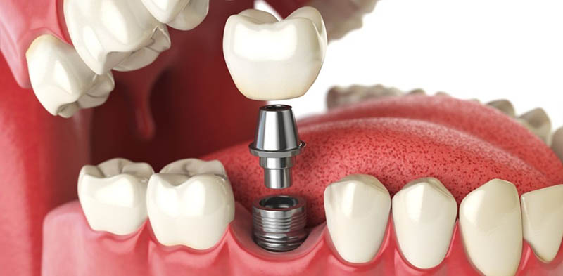 Trồng răng hàm bị sâu bằng cách cấy ghép Implant