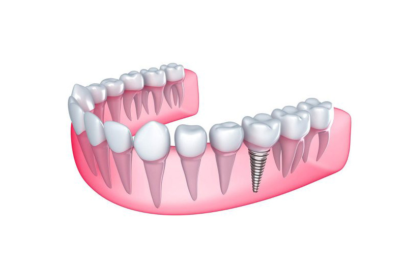Trồng răng Implant là phương pháp khôi khục răng đã mất cần can thiệp phẫu thuật