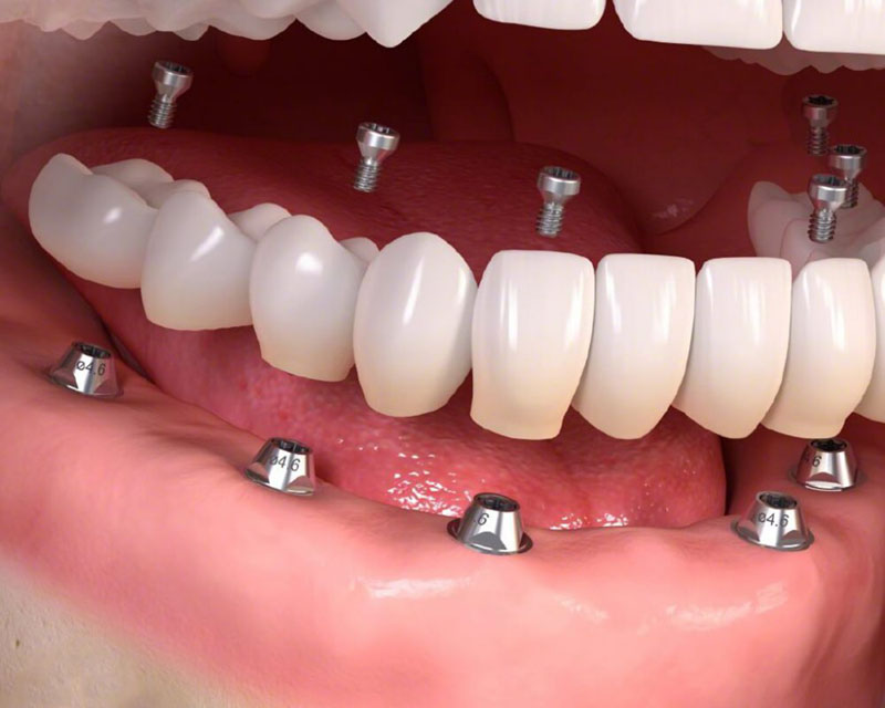 Trồng răng Implant nên tránh ăn thức ăn dai, cứng dễ làm tổn thương răng, lợi