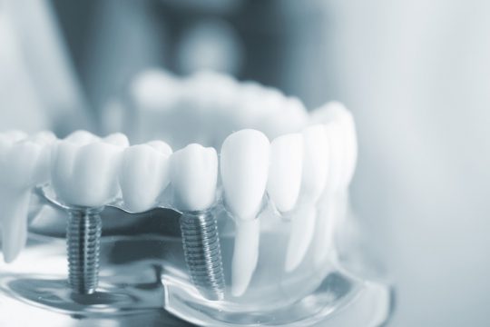 Trồng Răng Implant Kiêng Ăn Gì Để Tránh Nguy Cơ Nhiễm Trùng?