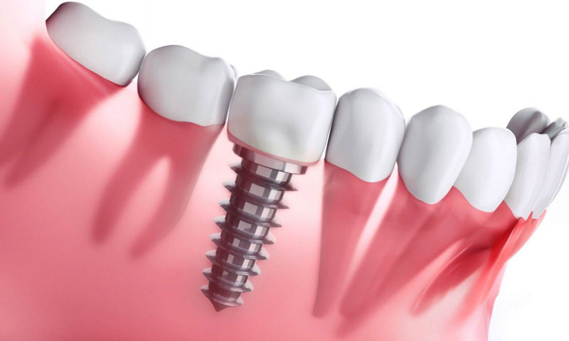 Cấy ghép Implant là phương án điều trị mất răng tiên tiến nhất hiện nay