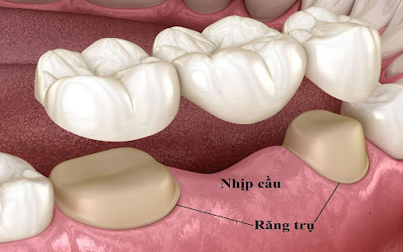 Nhiều người áp dụng phương pháp cầu răng sứ để trồng răng số 6