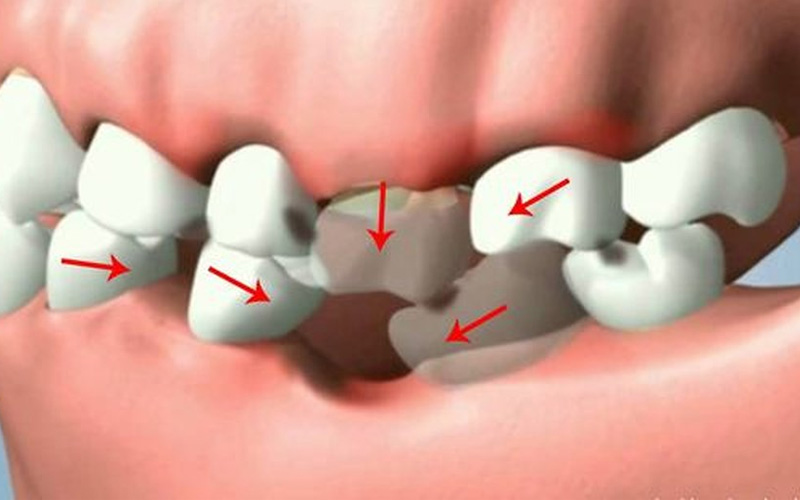 Những lưu ý cần ghi nhớ mà ai cũng cần phải biết trong quá trình trồng răng số 6
