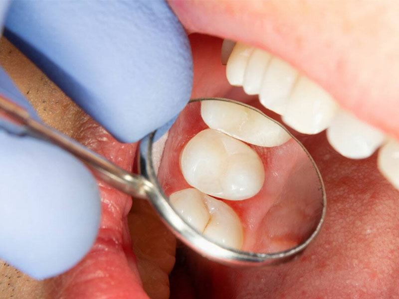 Phương pháp trám răng thẩm mỹ được nhiều người áp dụng