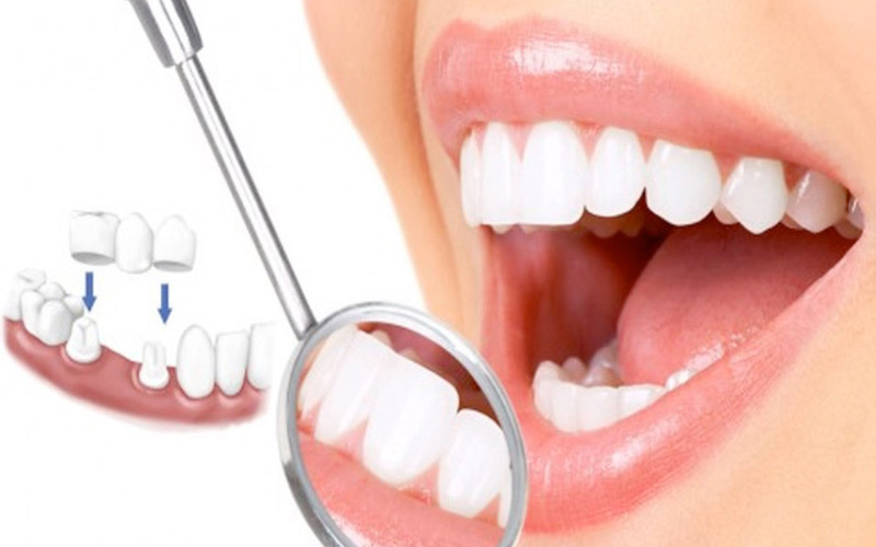 Bọc răng sứ thẩm mỹ là phương pháp phổ biến được nhiều người sử dụng