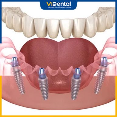 Sự khác biệt giữa trồng răng bằng cầu răng sứ và cấy ghép implant