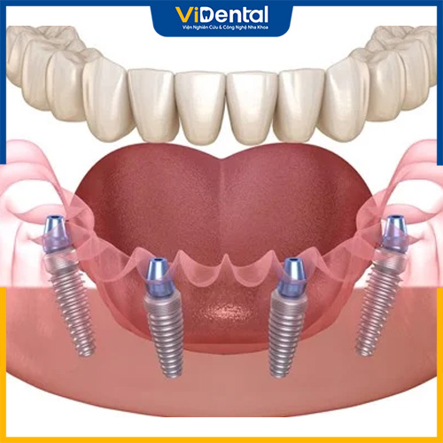 Sự khác biệt giữa trồng răng bằng cầu răng sứ và cấy ghép implant