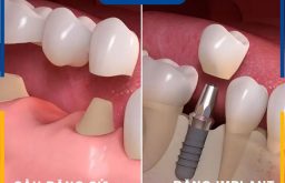 Trồng Răng Bằng Cầu Răng Sứ Và Implant: Cách Nào Tốt Nhất?