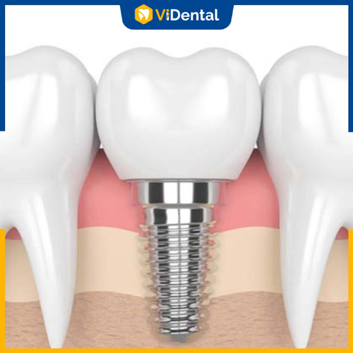 Trông răng Implant là giải pháp chỉnh hình phổ biến