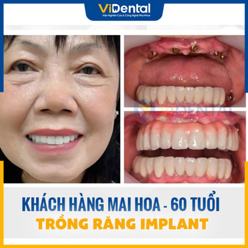 Review trồng răng Implant của khác hàng tại Trung Tâm ViDental Implant