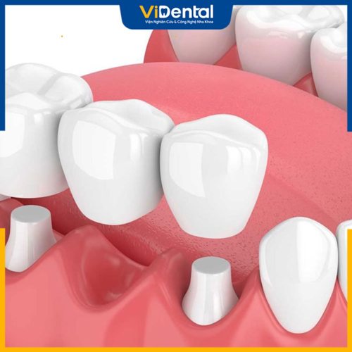 Trồng răng cấm bằng cầu răng sứ giá bao nhiêu phụ thuộc nhiều yếu tố