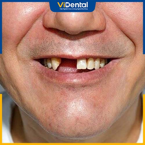 Những người bị mất răng cần gắn trụ để ổn định xương hàm
