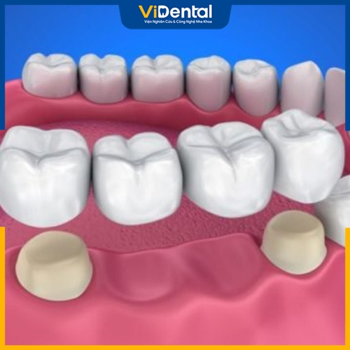 Cầu răng sứ là phương pháp phục hình răng thẩm mỹ phổ biến
