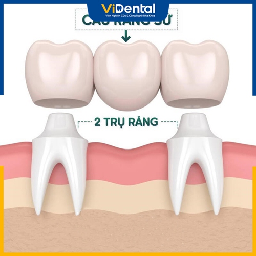 Cầu răng sứ răng cửa có nhiều ưu điểm vượt trội