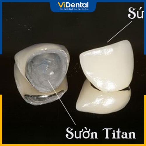 Cầu răng sứ Titan có nhiều ưu điểm vượt trội