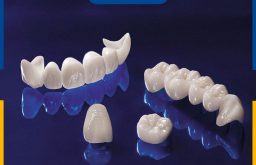 Cầu răng sứ Titan có nhiều ưu điểm vượt trội như an toàn, chi phí rẻ