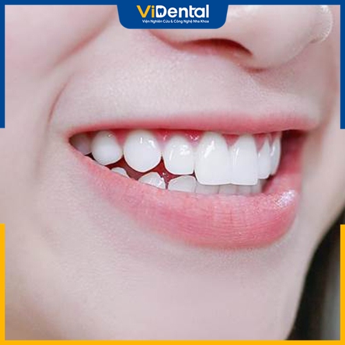 Làm cầu răng số 6 có nhiều ưu điểm vượt trội