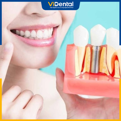 Trồng răng giả cố định là một cách phục hình răng bị mất