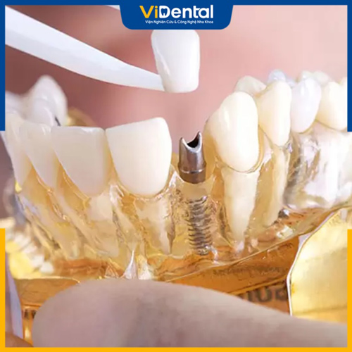 Chi phí trồng răng sứ cố định phụ thuộc nhiều yếu tố khác nhau