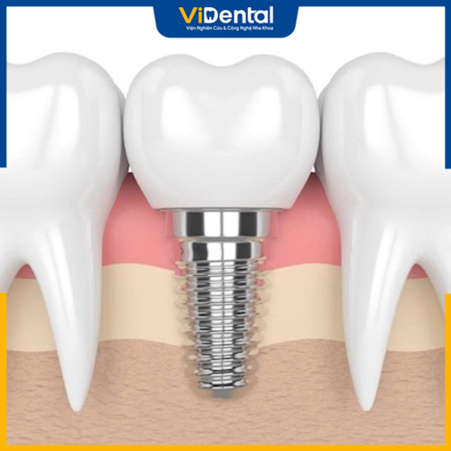 Trồng răng Implant sở hữu nhiều ưu điểm vượt trội