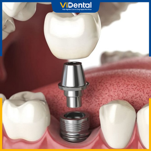 Phương pháp trồng răng cố định bằng Implant được khuyến nghị