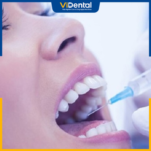 Thuốc tê, giảm đau sẽ giúp mang lại sự nhẹ nhàng khi trồng răng