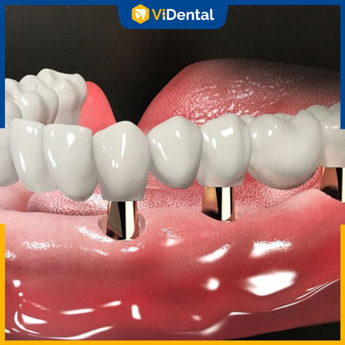 Trồng răng sứ nguyên hàm được áp dụng cho các trường hợp mất răng toàn hàm