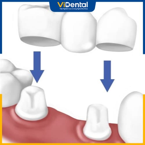 Làm cầu răng sứ trồng răng số 7 thường yêu cầu mài răng số 6 và 8