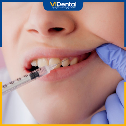 Quá trình trồng răng diễn ra với sự hỗ trợ từ thuốc tê