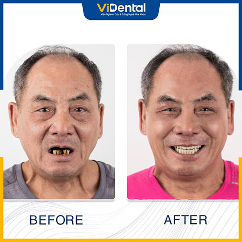 Vidental đã thực hiện trồng răng thành công cho nhiều trường hợp