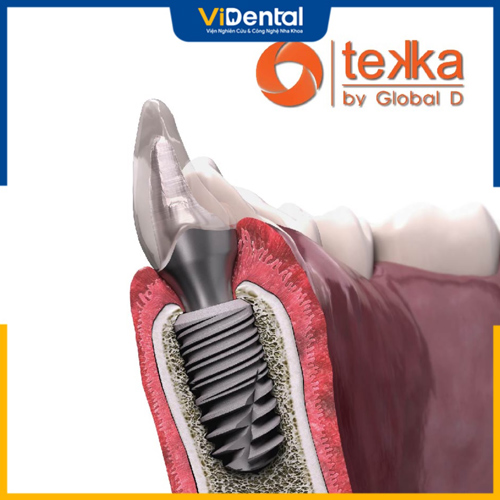 Trụ Implant Tekka được ưa chuộng trên thị trường Châu Âu