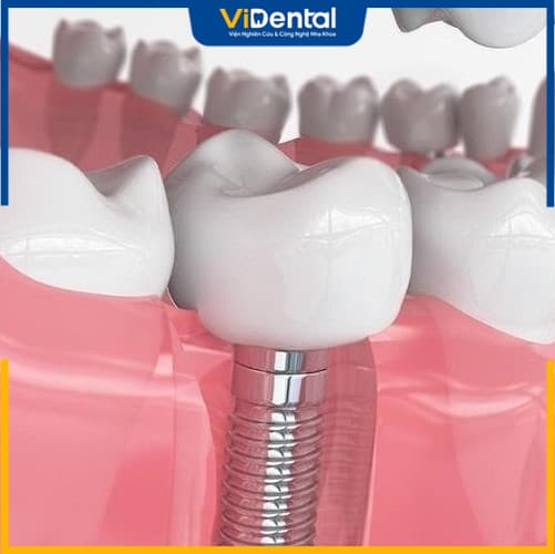 Trồng răng implant- phương án tốt nhất cho răng số 7 bị mất 