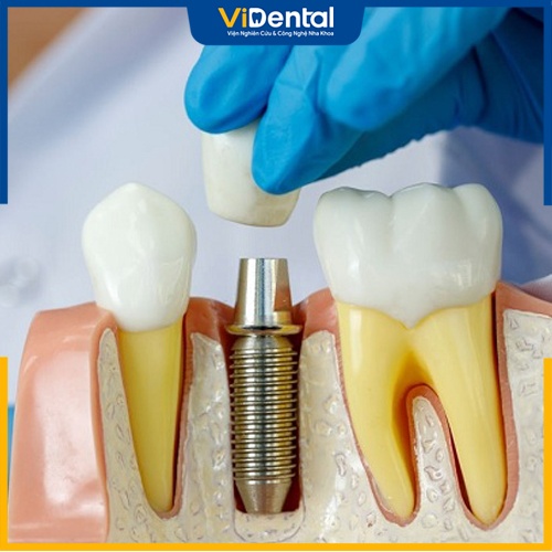 Phục hình răng bằng phương pháp Implant