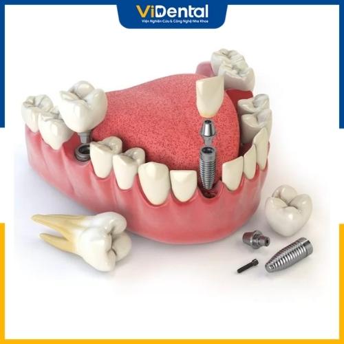 Trồng răng hàm số 7 bằng phương pháp Implant