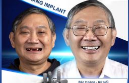 Sự thay đổi ngoạn mục của bác Hoàng sau khi trồng răng Implant