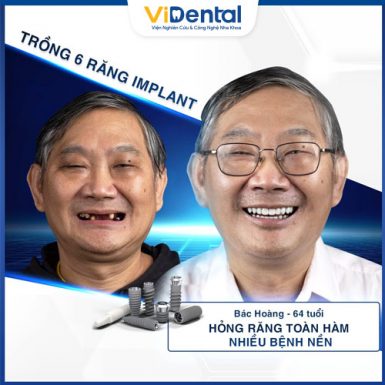 Sự thay đổi ngoạn mục của bác Hoàng sau khi trồng răng Implant
